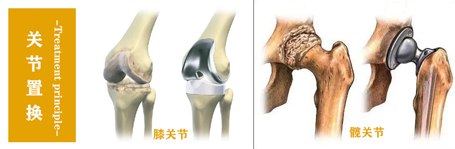 關節(jié)置換