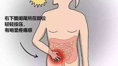 慢性闌尾炎需要切除嗎？